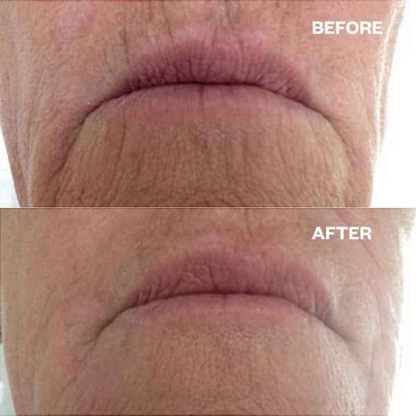 Wrinkles Schminkles Parche Para Boca y Labios